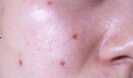 给吃瓜的男孩点痣好吗视频,见证颜值逆袭之旅