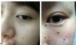 给吃瓜的男孩点痣好吗视频,见证颜值逆袭之旅